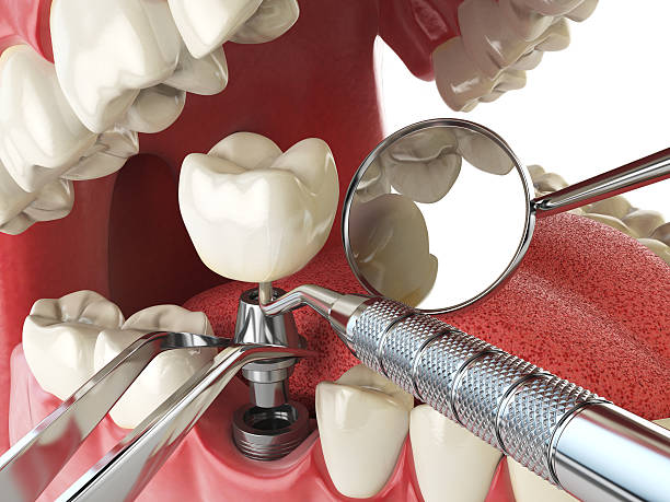 Best Emergency Root Canal Treatment in Havana, IL